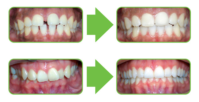 Clear Aligner Therapy Saxe Orthodontics