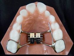 Types of Appliances | Saxe Orthodontics