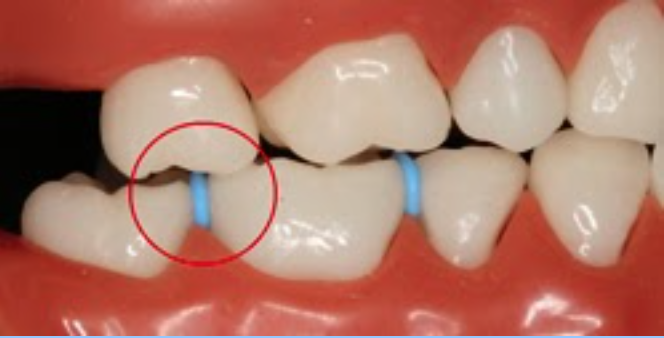 Separators are tiny rubber bands that fit between the teeth.