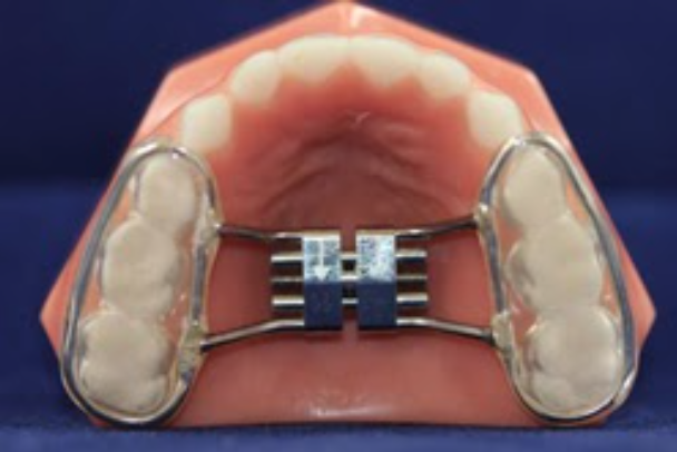 A Bonded RPE is similar to a traditional RPE, except this one is bonded to the teeth.