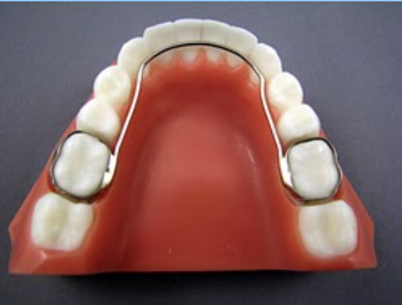 Lower Lingual Arch is essentially a space maintainer appliance, used on the lower erupting permanent teeth.