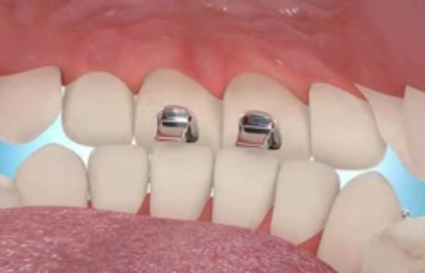 Bite Turbos are small metal or acrylic “bumpers”, bonded to the molars to prevent to prevent the top teeth from excessively overlapping the bottom teeth.