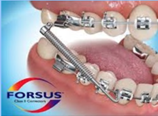 The Forsus Fatigue Resistant Device is a fixed appliance designed to encourage proper growth of the jaw bones.
