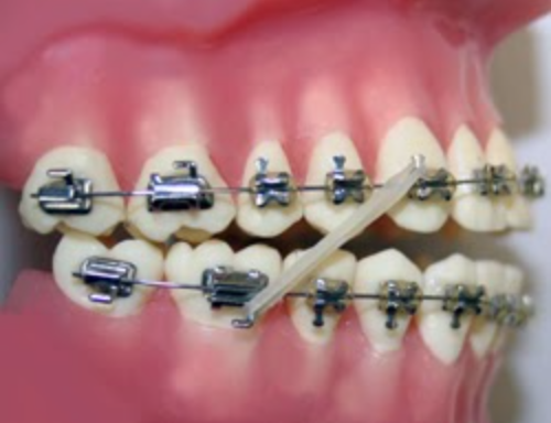 Elastics (rubber bands) are tiny appliances, hooked around a braces bracket on the top teeth and a braces bracket on the bottom teeth to align one arch to another.