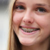 Smiling girl wonders about cavities with braces