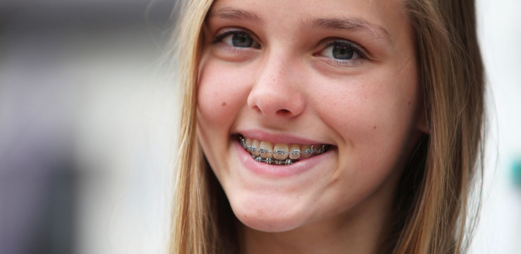 Smiling girl wonders about cavities with braces