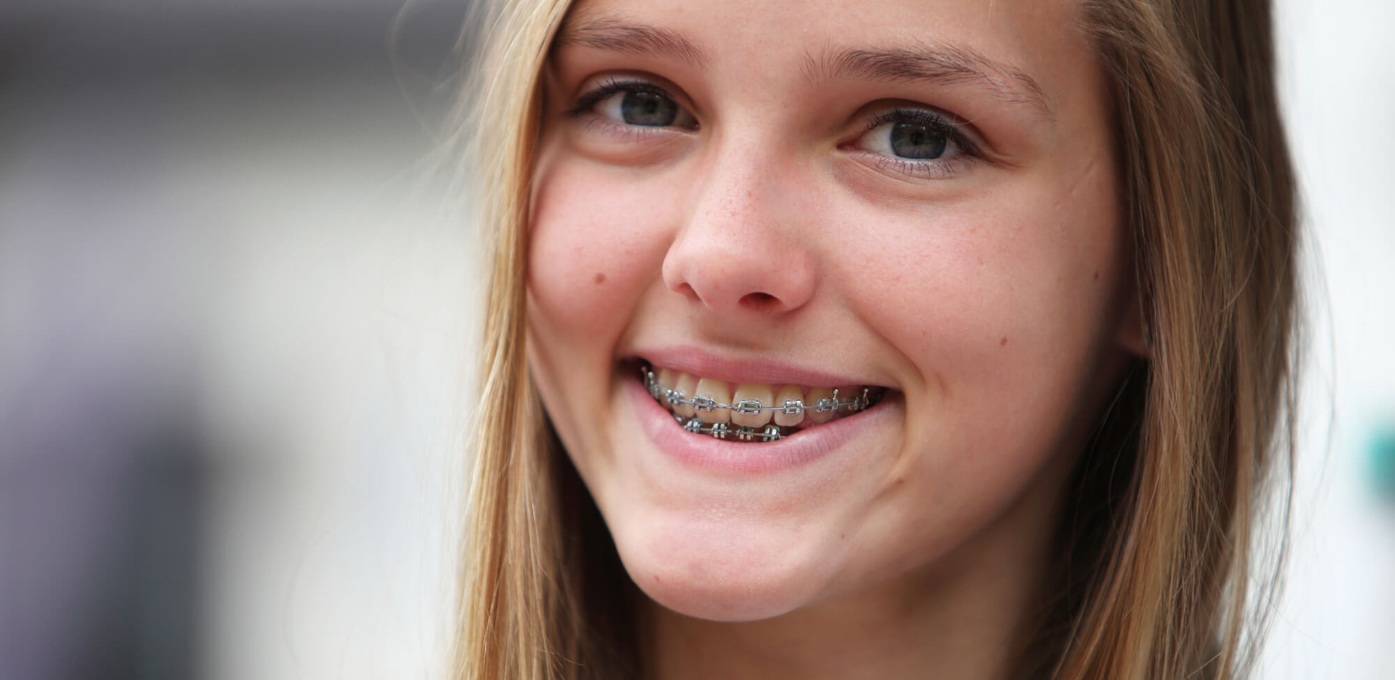 Can I get cavities filled with braces? How do I prevent them?
